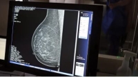 Pesquisadores brasileiros desenvolvem tecnologia para mamografia sem desconforto